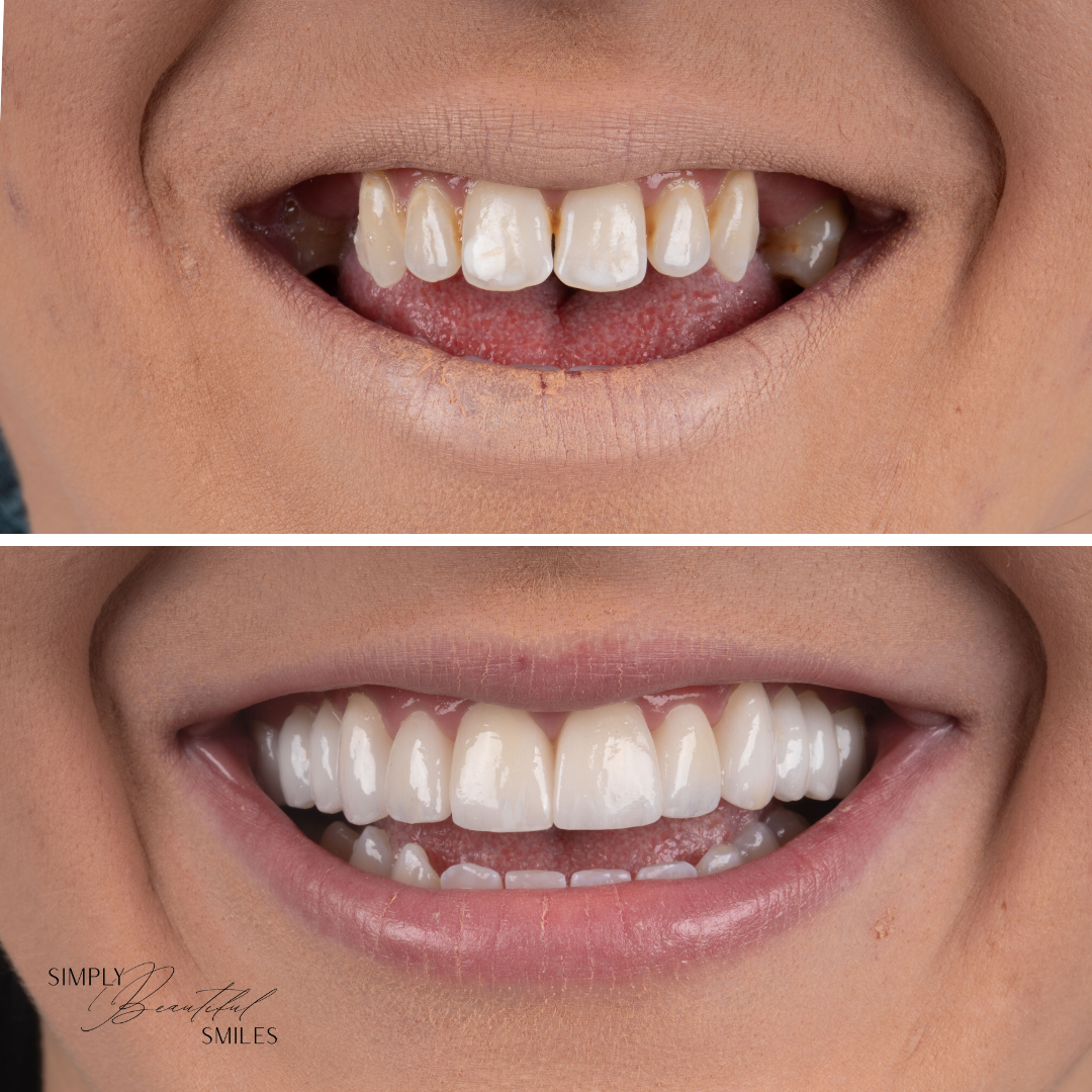 A beautiful smile makeover using a dental bridge and veneers