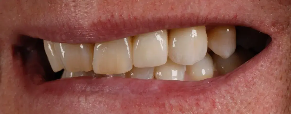 Complete Smile Makeovers » Simply Beautiful Smiles